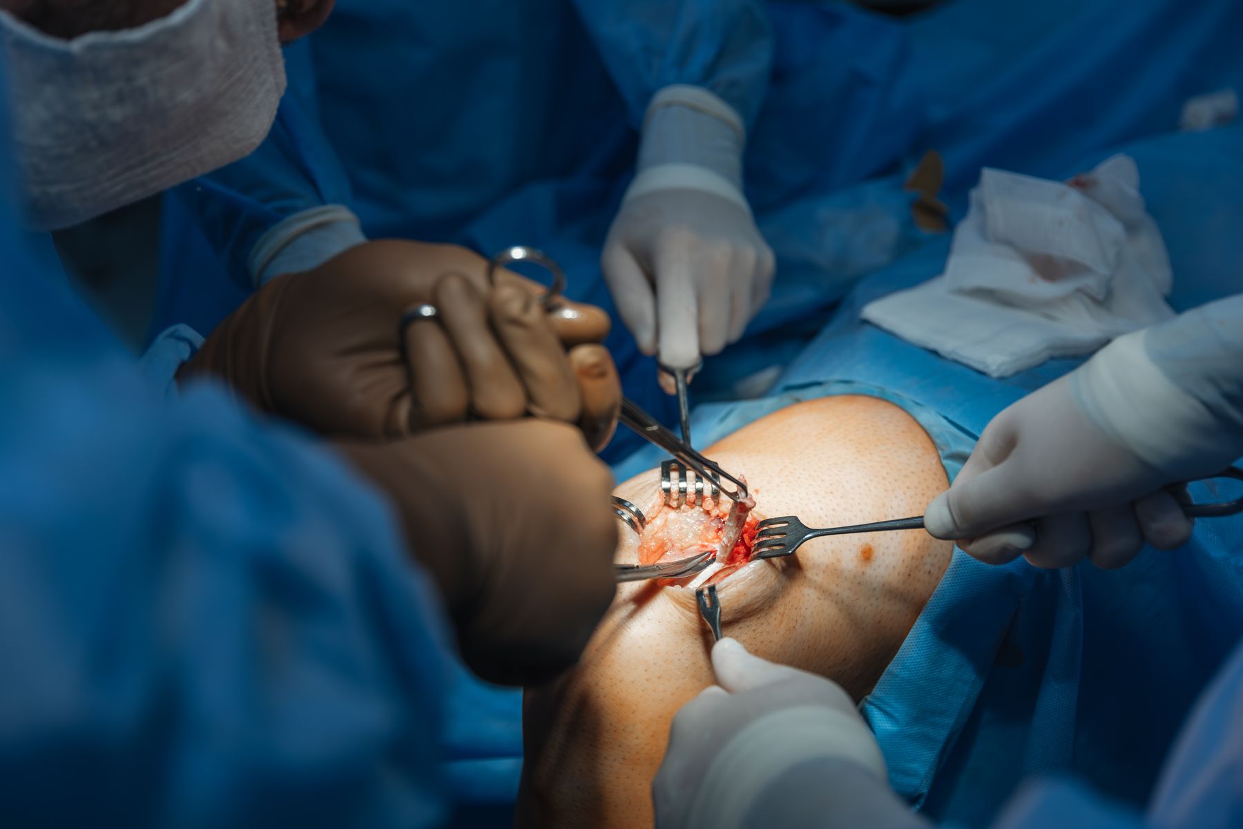 closeup-severed-human-knee-operating-table-where-knee-replacement-surgery-is-being-performed